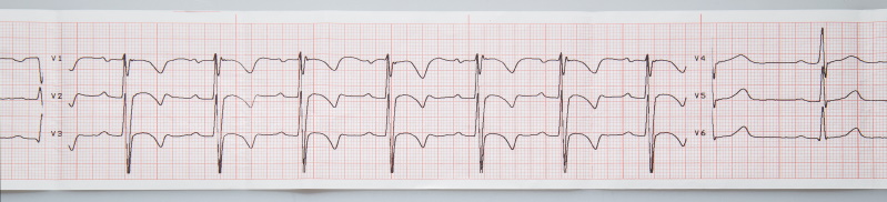 electrocardiogram of a toddler