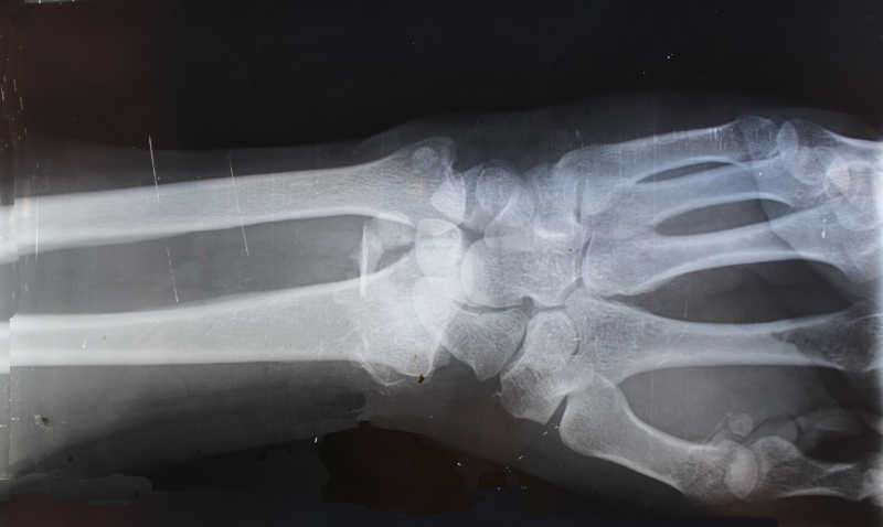 X ray of hand and arm